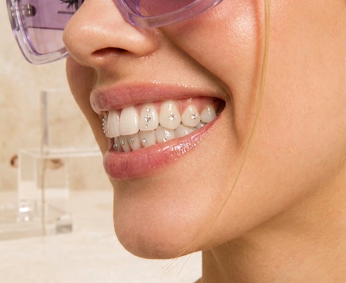 Smile with a tooth gem — customer result 2